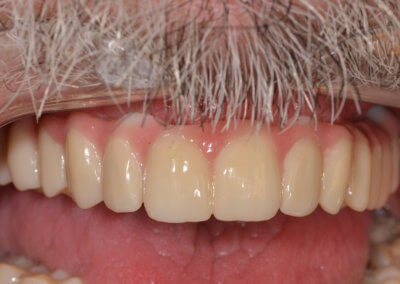 Upper fixed bridge on 5 implants