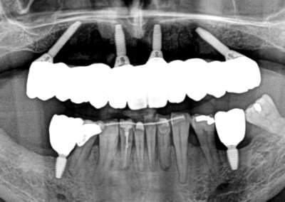 Upper all-on-four zirconia bridge