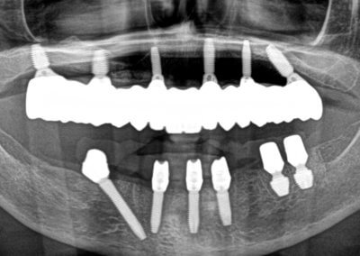 Upper fixed bridge on 6 implants