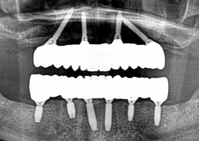 Upper and lower fixed zirconia bridges on implants