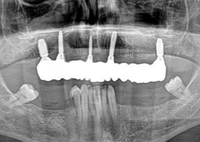 Upper fixed bridge on 5 implants