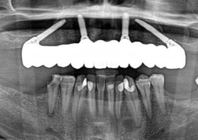 Upper all-on-four zirconia bridge