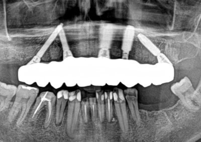 Upper fixed bridge on 5 implants