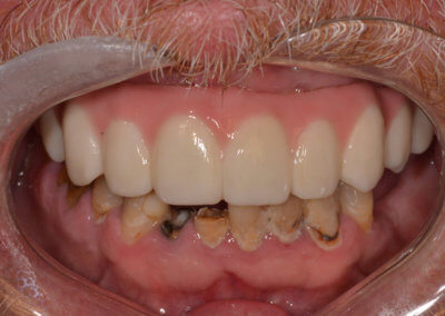 Upper fixed bridge on 5 implants