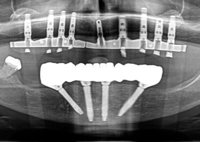 Lower all-on-4 fixed zirconia bridge