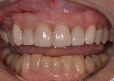 Upper old six veneers