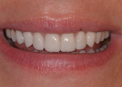 Upper eight veneers