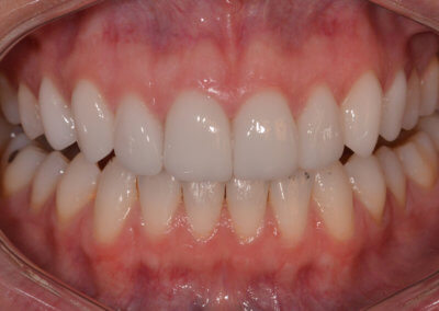 Upper eight veneers