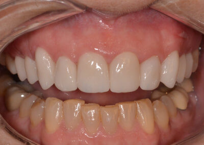 Upper new ten veneers