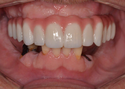 Upper fixed bridge on 4 implants