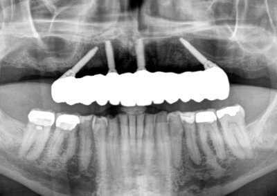 Upper fixed bridge on 4 implants