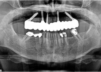 Upper fixed bridge on 5 implants