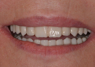 Upper and lower fixed zirconia bridges on implants