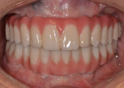 Upper and lower fixed zirconia bridges on implants