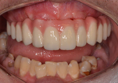 Upper fixed bridge on 4 implants