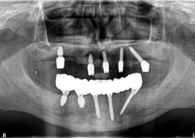 Lower fixed bridge on implants