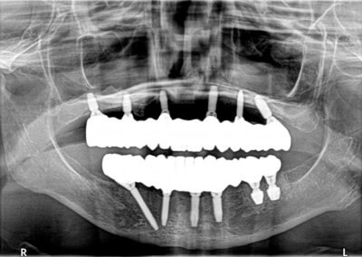 Upper and lower fixed zirconia bridges on implants