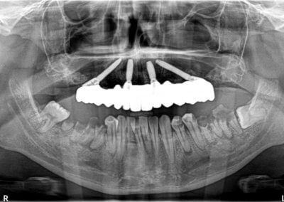 Upper fixed bridge on 4 implants