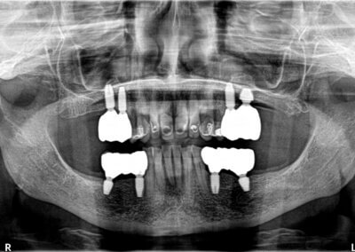 Two sinus grafts, eight implants and four bridges