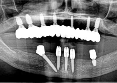 Upper fixed bridge on 7 implants